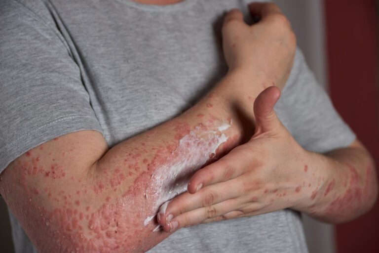 psoriase-sintomas-causas-tratamento